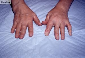 Tophaceous gout before and after allopurinol. Time several years.