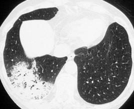 Interstitial lung disease